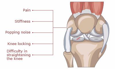 Symptoms-of-ligament-injury